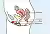 Snippan i genomskärning. Bilden visar var i slidan femidomen ska sitta. Illustration. 