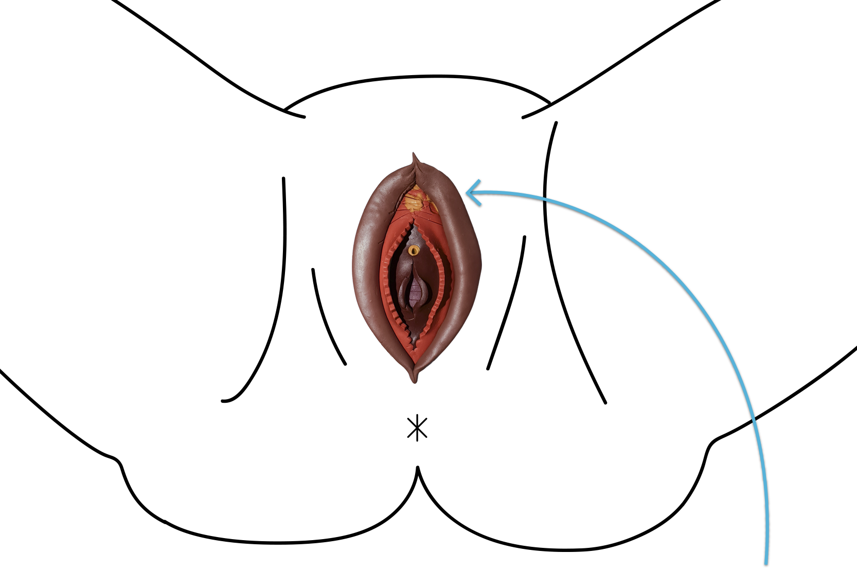 En lermodell av en snippa där toppen av klitoris och huden runt klitoris skurits bort.